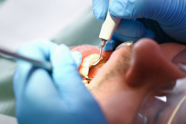Emergency Dental Filling Replacement in AR
